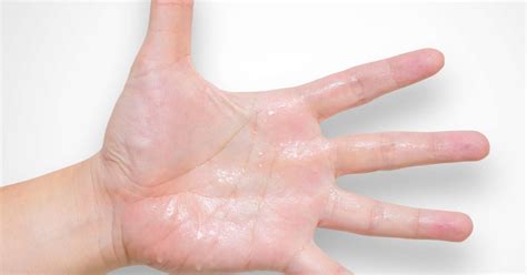 Clammy skin: Causes, pictures, and treatment