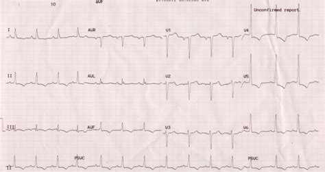 Left ventricular hypertrophy with strain pattern – All About ...