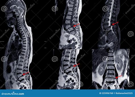 MRI of Lumbar Spine Showing Cervical Spondylosis with Mild To Moderate Spinal Cord Compression ...