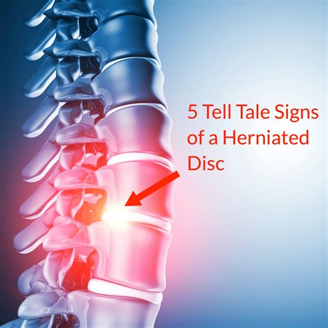 5 Tell Tale Signs of a Herniated Disc (Slipped Disc) - Fornham Chiropractic Clinic