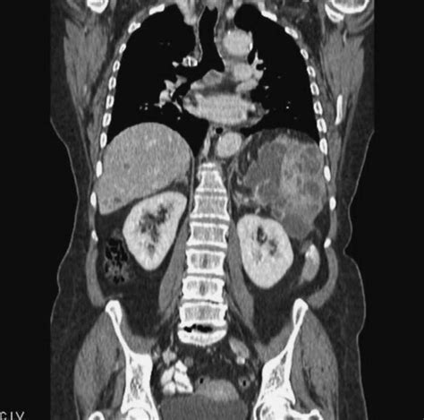 Tomografía de abdomen y pelvis