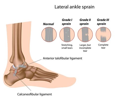 Ankle Sprain Rehab - Symmetry Physical Therapy Downtown Miami ...