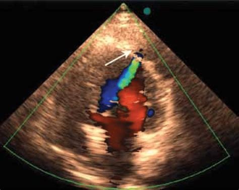 Two-dimensional echocardiogram with Color Flow Doppler in the apical ...