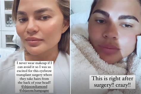 Chrissy Teigen undergoes eyebrow transplant surgery