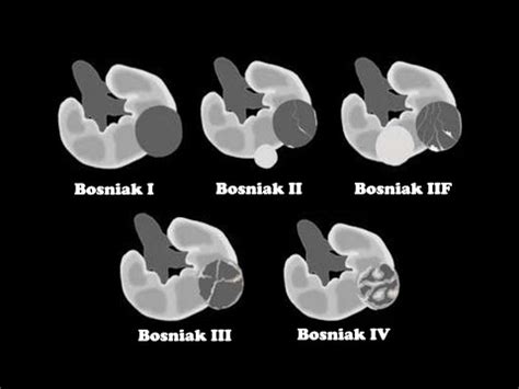 Bosniak Classification for Renal Cystic Disease - YouTube