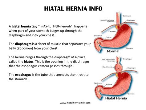 Hiatus Hernia Diet After Surgery - UrbanDine