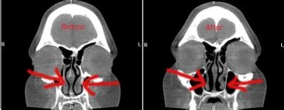 7 Weeks After Septoplasty/Turbinate Reduction and Can't Breathe While Standing? (photo) Doctor ...