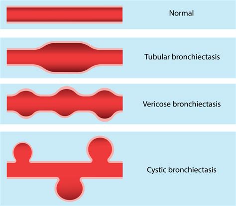 Causes, Symptoms, Diagnosis and treatment of bronchiectasis | Holistic ...