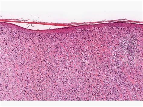 Dermpath Made Simple - Neoplastic: Atypical Fibroxanthoma