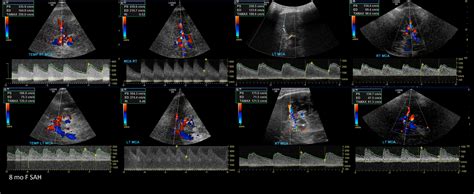 Transcranial Doppler – Sonographic Tendencies | Vascular ultrasound ...