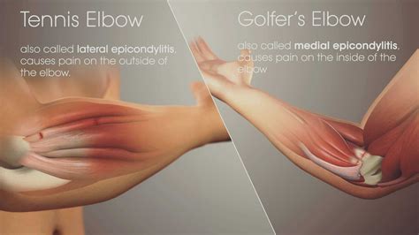 Tennis Elbow - Diagnosing & General advice - Chris Tinney Sports & Swedish Massage