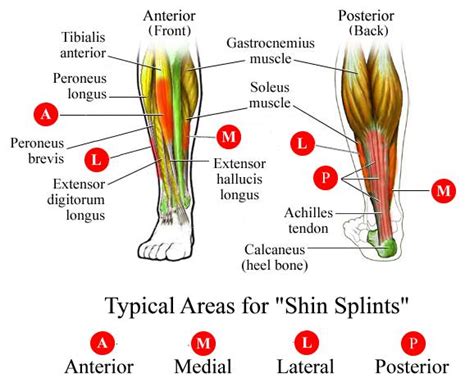 Podiatry for Shin Splints | Sutherland Podiatry Centre