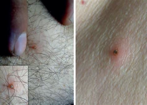 photo-of-tick-bite-1 - Pest Hacks