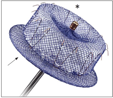 Update on Left Atrial Appendage Occlusion - Cardiac Interventions Today