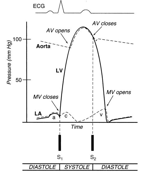 Wiggers Diagram Aortic Regurgitation