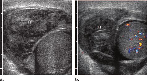 Extratesticular hematoma in a patient with scrotal swelling after a... | Download Scientific Diagram