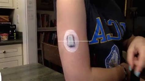 How to Insert Dexcom G4 Sensor in Arm - YouTube