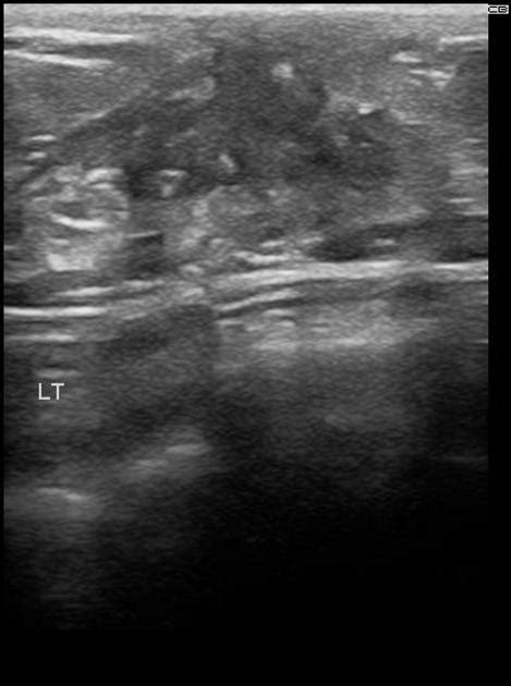 Male Gynecomastia Ultrasound