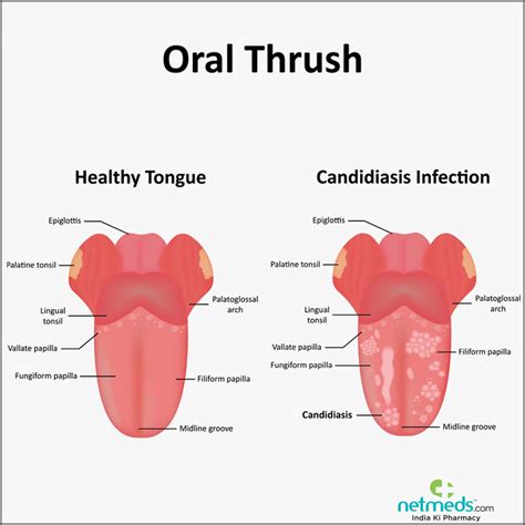 Oral Thrush - Causes, Symptoms And Treatment