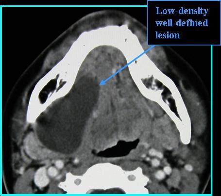 Ranula - Radiology | Iowa Head and Neck Protocols