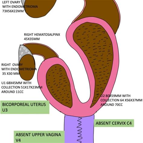 Ultrasound Images of (A) Images of bicorporeal uterus with hematometra ...