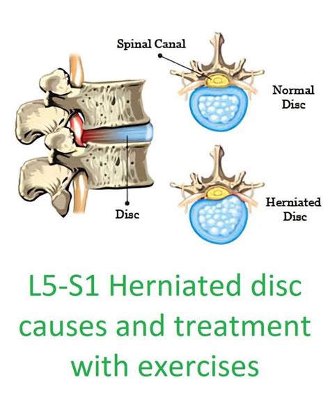 Herniated disk in lower back causes and relief with 3 exercises