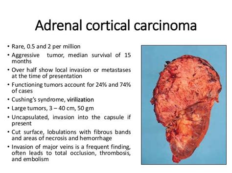 Adrenal gland diseases and tumors