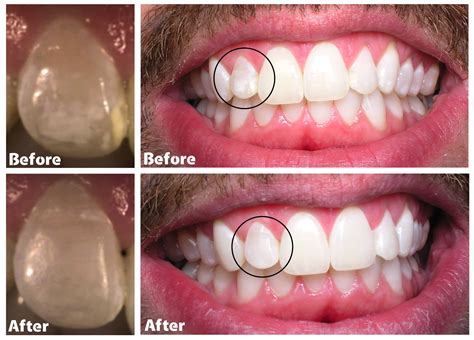 White Spot Lesions Orthodontics