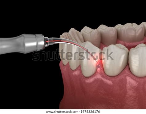 410 Laser Gum Treatment Images, Stock Photos & Vectors | Shutterstock