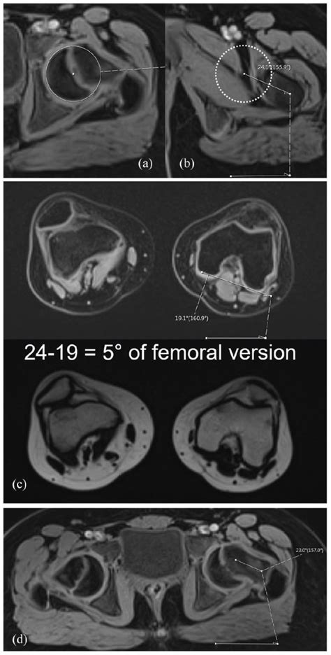 Assessment of femoral retroversion on preoperative hip magnetic ...