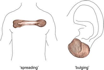 Frontiers | The Keloid Disorder: Heterogeneity, Histopathology, Mechanisms and Models