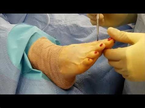 Dr. Paul Steinke performs a Fusion of the Great Toe Joint for Hallux ...