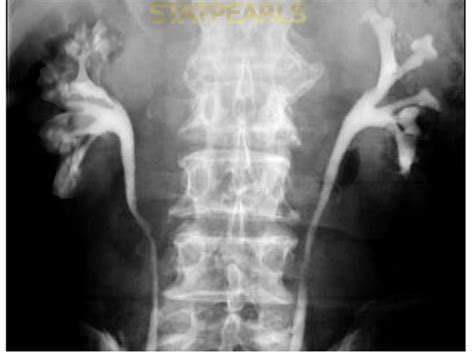 [Figure, Medullary sponge kidney] - StatPearls - NCBI Bookshelf