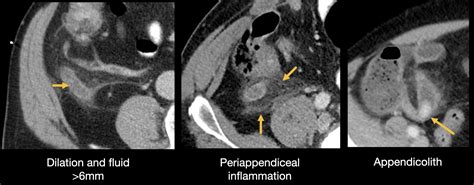 Abdominal CT: appendicitis • LITFL • Radiology Library