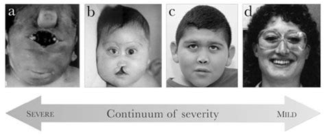 Holoprosencephaly | Medical oddities, Medical conditions, Neonatology