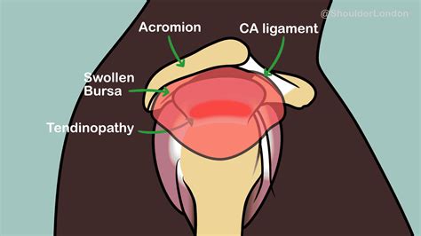 What is shoulder bursitis?