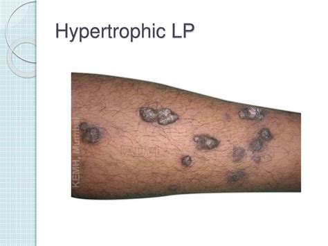 PPT - Lichen Planus PowerPoint Presentation, free download - ID:2278042