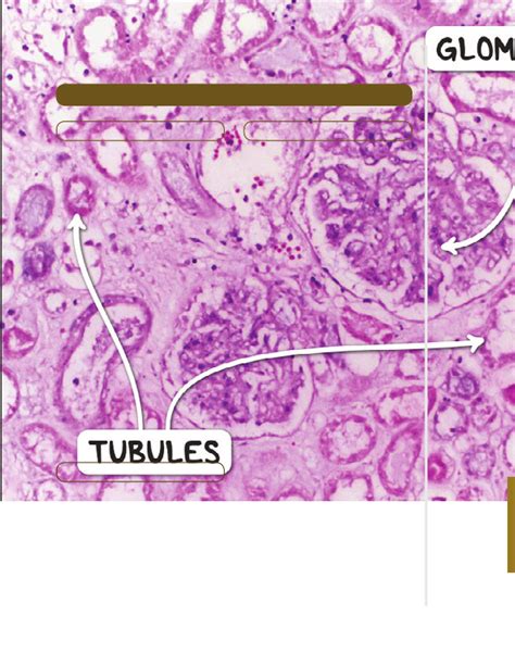 Vascular renal disease Notes: Diagrams & Illustrations | Osmosis