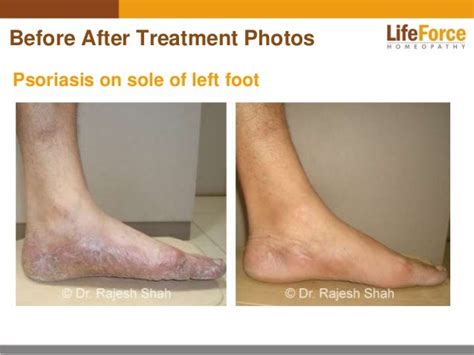 Psoriasis on Legs Photos: Before After Treatment Pictures of Patients…