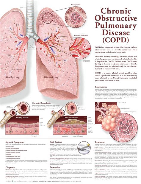 Chronic Obstructive Pulmonary Disease: What You Should Know Infographic