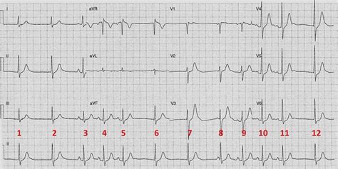 ECG of the Week: ECG of the Week - 4th November 2013 - Interpretation