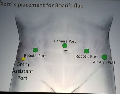 NARUS 2019: Boari Flap - Stepwise Approach to Surgical Management