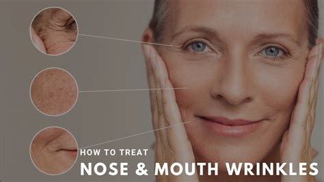 How To Treat Nose And Mouth Wrinkles Wrinkles Treatment Winston Salem ...