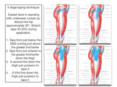 Gluteal Tendinopathy - RunningPhysio