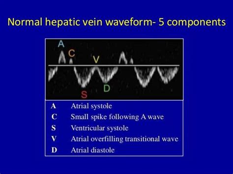 Hepatic Vein - Normal Waveform of 5 components. | Cardiología