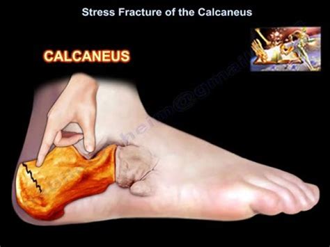 Stress Fracture Heel - Therapy NYC