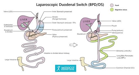 Biliopancreatic Diversion With Duodenal Switch