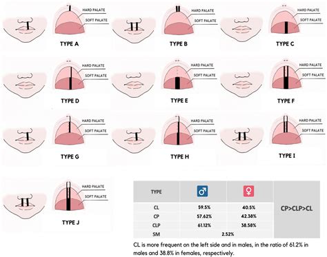 Types Of Cleft Palate