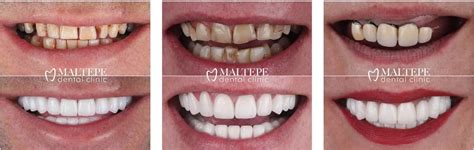 Zirconium Dental Crowns: Details, Cost and Procedure [2023] - Maltepe Dental Clinic