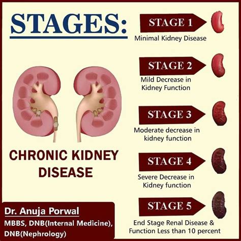 What Is 3 Stage Kidney Disease - HealthyKidneyClub.com